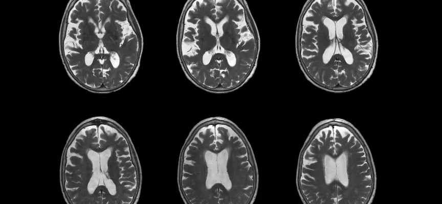 ABD Gıda ve İlaç Dairesi, Alzheimer’ı yavaşlattığı gözlenen yeni ilacı onayladı